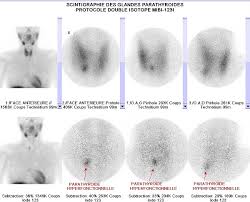 Thyroid scintigraphy (ts) with either 99mtco4 or 123i will identify ectopic thyroid tissue, which is the commonest cause of ch. Scintidome La Scintigraphie Des Glandes Parathyroides