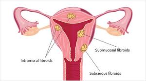 A New Understanding Of Uterine Fibroids Health Answers