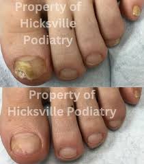 toenail fungus before after photos
