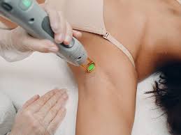 armpit laser hair removal procedure