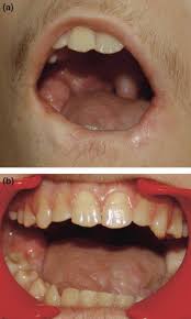 complete wound healing of the lower lip