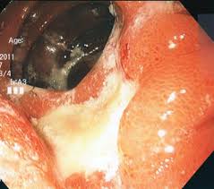 stomach ulcer after gastric byp surgery