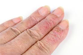 can eczema affect your fingernails