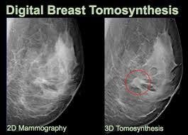 Digital Breast Tomosynthesis Marnieclark Com
