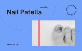 what is nail patella syndrome causes