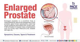 https://www.pacehospital.com/enlarged-prostate-symptoms-causes-and-treatment gambar png
