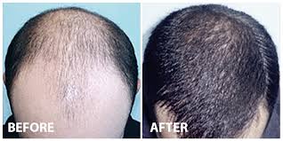 hair reversal solution hair stem cell