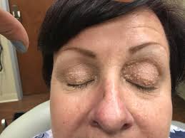 They are most often seen on the skin around the cheeks, nose, eyes and multiple eruptive milia. Milia 101 You Re Not Just One In A Milium Dr Pimple Popper