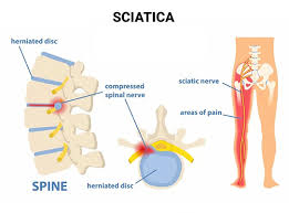sciatica pain imate relief cure