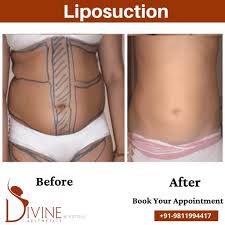 liposuction surgery in mumbai