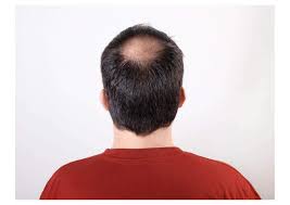 home remes for alopecia or hair loss
