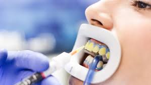 Ein zahnbleaching kann in diesem fall helfen. Bleaching Moglichkeiten Der Zahnaufhellung Kostenfalle Zahn