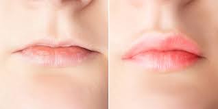 enhance your thinning ageing lips with