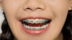 How can rubber bands help with my teeth straightening? Braces With Rubber Bands Purpose And How Long They Stay On