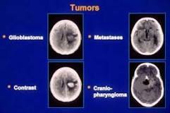 Image result for icd 10 code for malignant neoplasm of brain