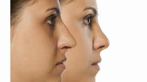 rhinoplasty swelling ses