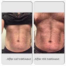 what is emsculpt does it work