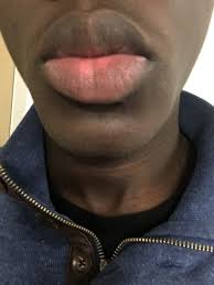 discoloration on my bottom lip photo