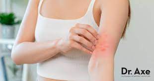 eczema treatment symptoms causes