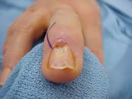 tumor nail contour correction after