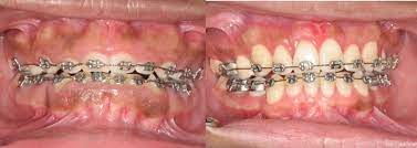 gums growing over braces nemeth