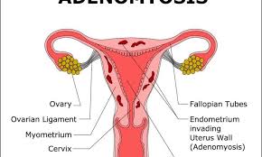 Adenomyosis Causes Pain Heavy Periods And Infertility But
