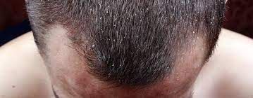 dandruff and hair loss causes and
