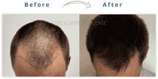 hair loss hair transplant growth