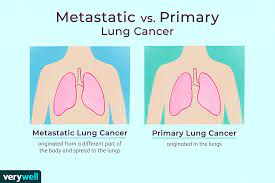 Here are some common symptoms of cancer that has spread: Metastatic Cancer To The Lungs Symptoms And Treatment