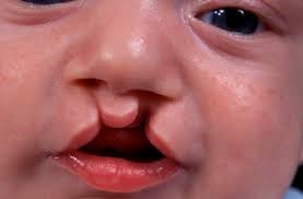 nhs 111 wales health a z cleft lip