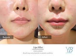 lip filler youth beauty clinic