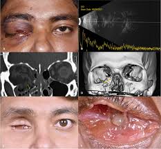 full article open globe injuries with
