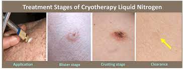 cryosurgery dermatology matters