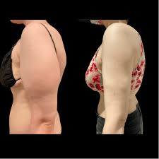 before after arms liposuction