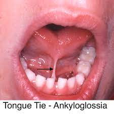tongue tie and lip tie frenectomy