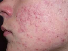 Image result for Inflammatory Acne (Papules and Pustules)