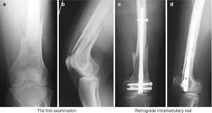 the distal femur fractures springerlink