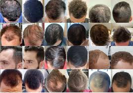 discover effective hair loss treatments