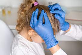 5 reasons why head lice may cause hair loss