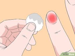 how to treat a smashed fingernail 12