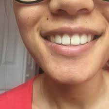 The process of braces can be painful but it one of the most efficient ways to get. Small Gaps After Braces I Took Off My Braces About Three Weeks Ago There Was No Gap Before I Had Braces Photos