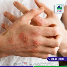 all you need to know about eczema treatment