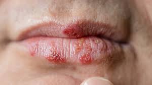 shingles symptoms with pictures