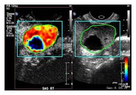 The results in 4350 patients confirmed that ultrasound examination, both transabdominal and transvaginal. Early Detection Of Ovarian Cancer With Conventional And Contrast Enhanced Transvaginal Sonography Recent Advances And Potential Improvements