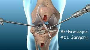 arthroscopic acl surgery knee pain