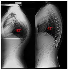 123rf.com.one particular type of kyphosis is. Scheuermann S Kyphosis Scoliosis And Spine Associates
