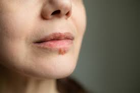 cold sores and hiv is there a link