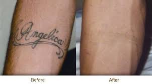 Tattoo removal san antonio pricing. Which Tattoo Removal Is Best