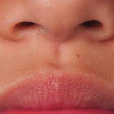 photograph of the patient s upper lip