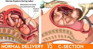 Image result for normal delivery images